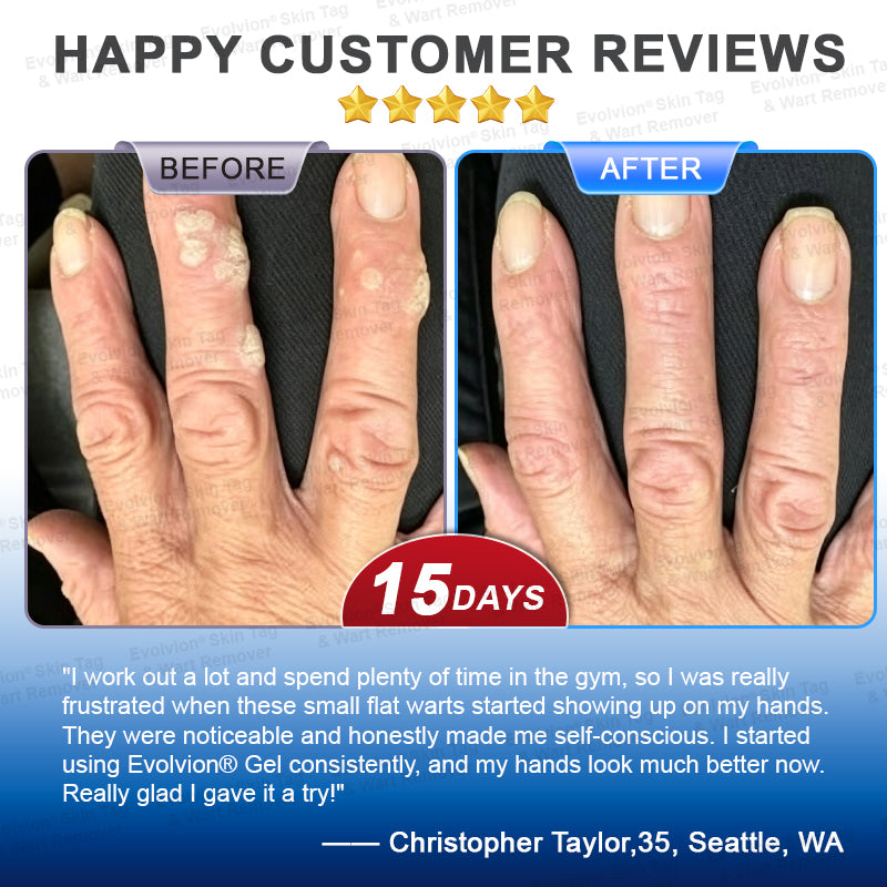 🌟🪄 BUY 1 GET 1 FREE🌟✨Evolvion® Skin Tag & Wart Remover Precision Gel- Last Day Promotion 70% OFF