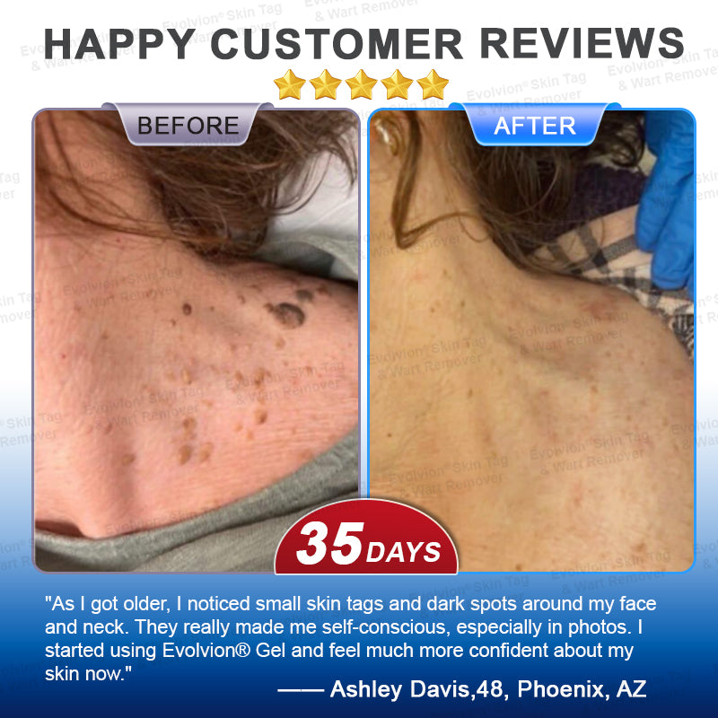 🌟🪄 BUY 1 GET 1 FREE🌟✨Evolvion® Skin Tag & Wart Remover Precision Gel- Last Day Promotion 70% OFF