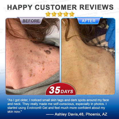 🌟🪄 BUY 1 GET 1 FREE🌟✨Evolvion® Skin Tag & Wart Remover Precision Gel- Last Day Promotion 70% OFF