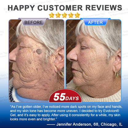 🌟🪄 BUY 1 GET 1 FREE🌟✨Evolvion® Skin Tag & Wart Remover Precision Gel- Last Day Promotion 70% OFF
