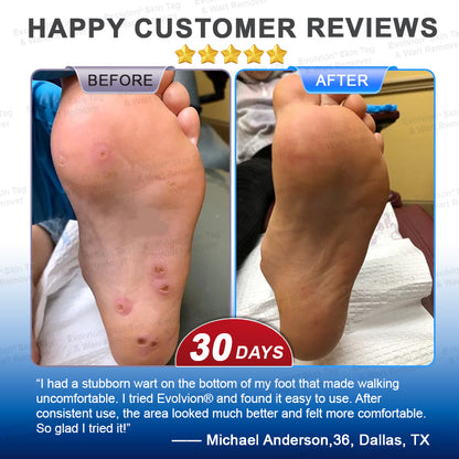 🔥 BUY 1 GET 1 FREE👍🌿✨Evolvion® Skin Tag & Wart Remover Precision Gel