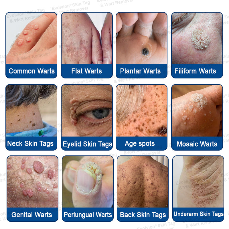 🌟🪄 BUY 1 GET 1 FREE🌟✨Evolvion® Skin Tag & Wart Remover Precision Gel- Last Day Promotion 70% OFF